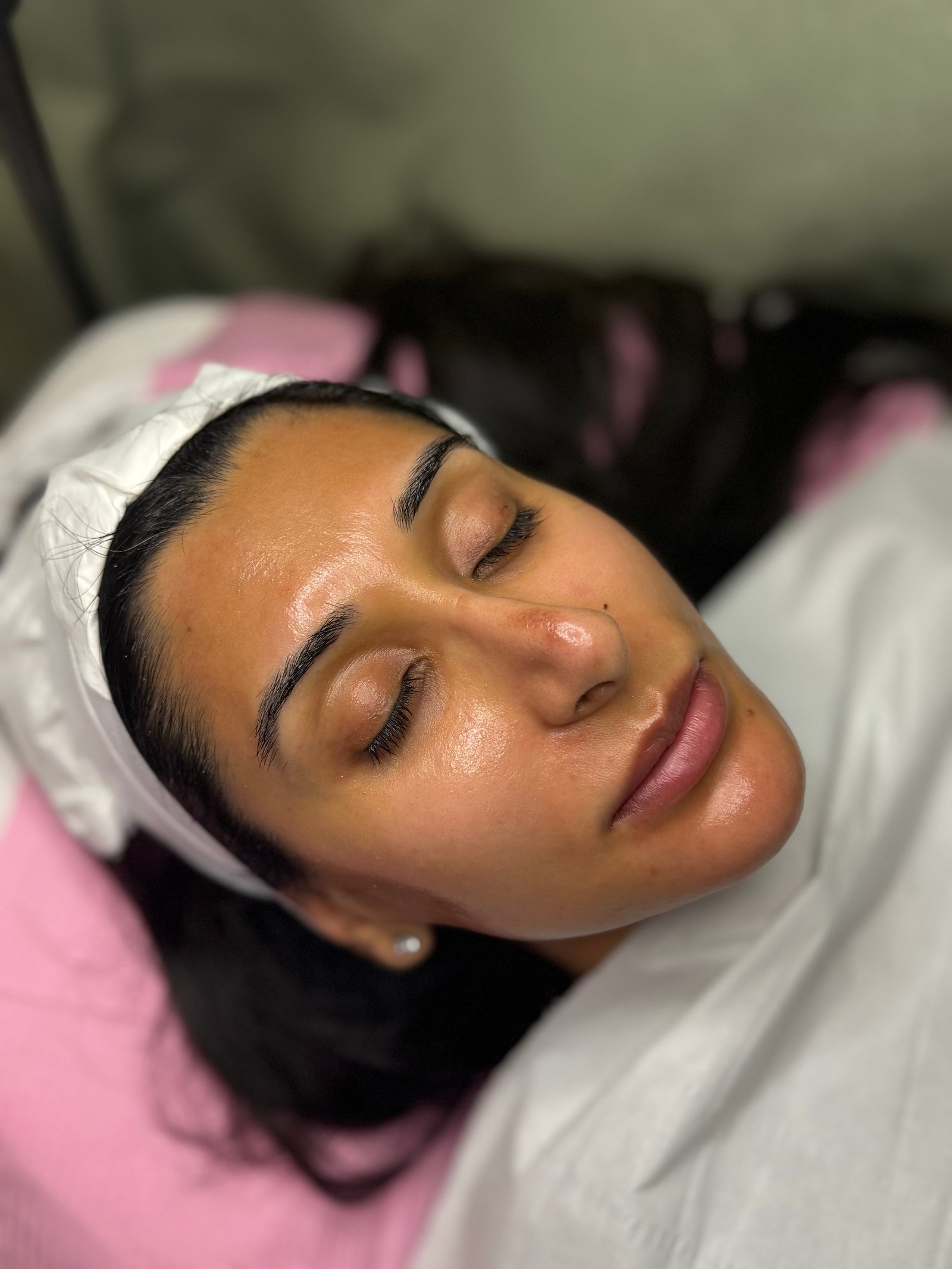 After microneedling