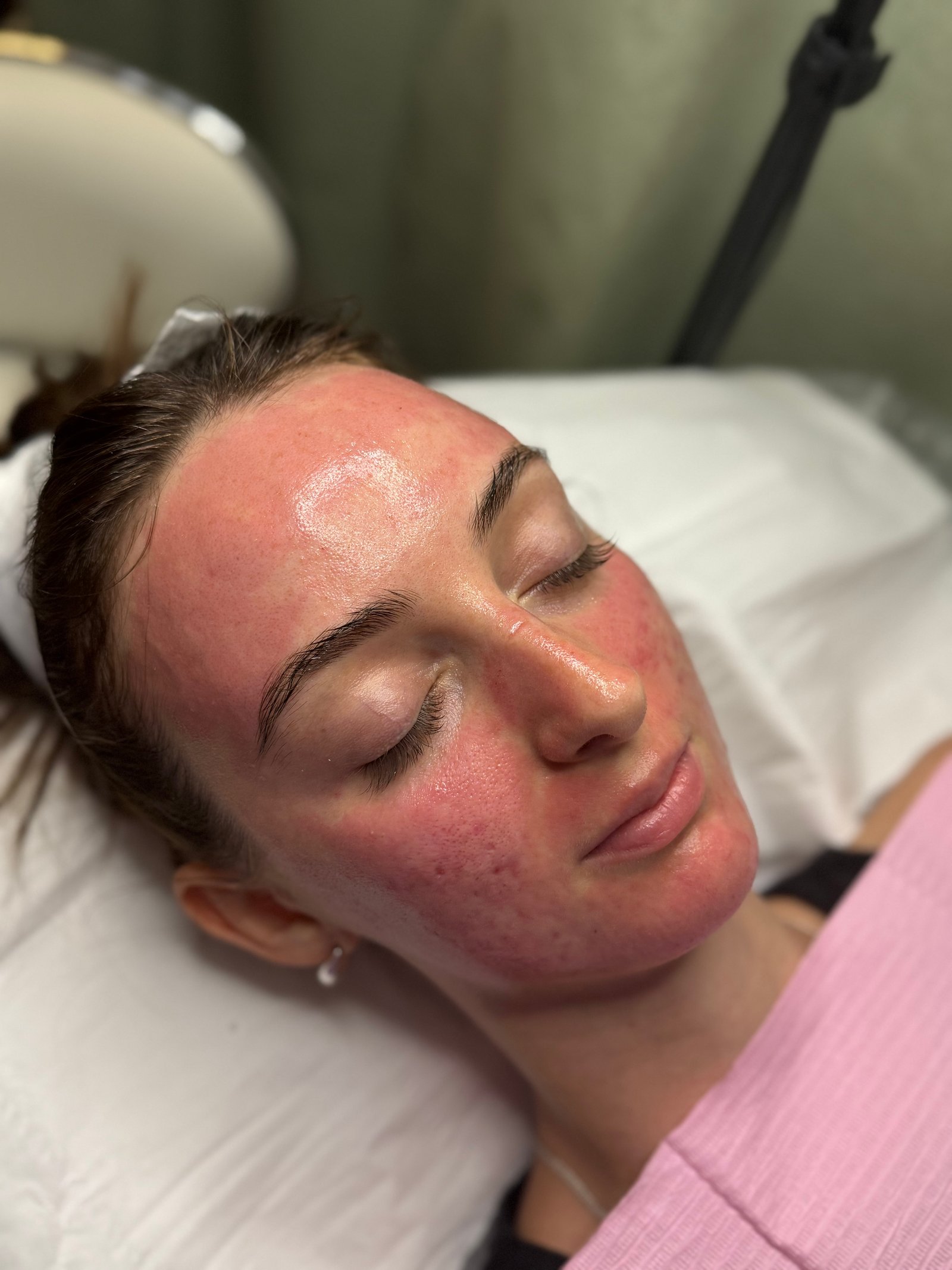 After microneedling