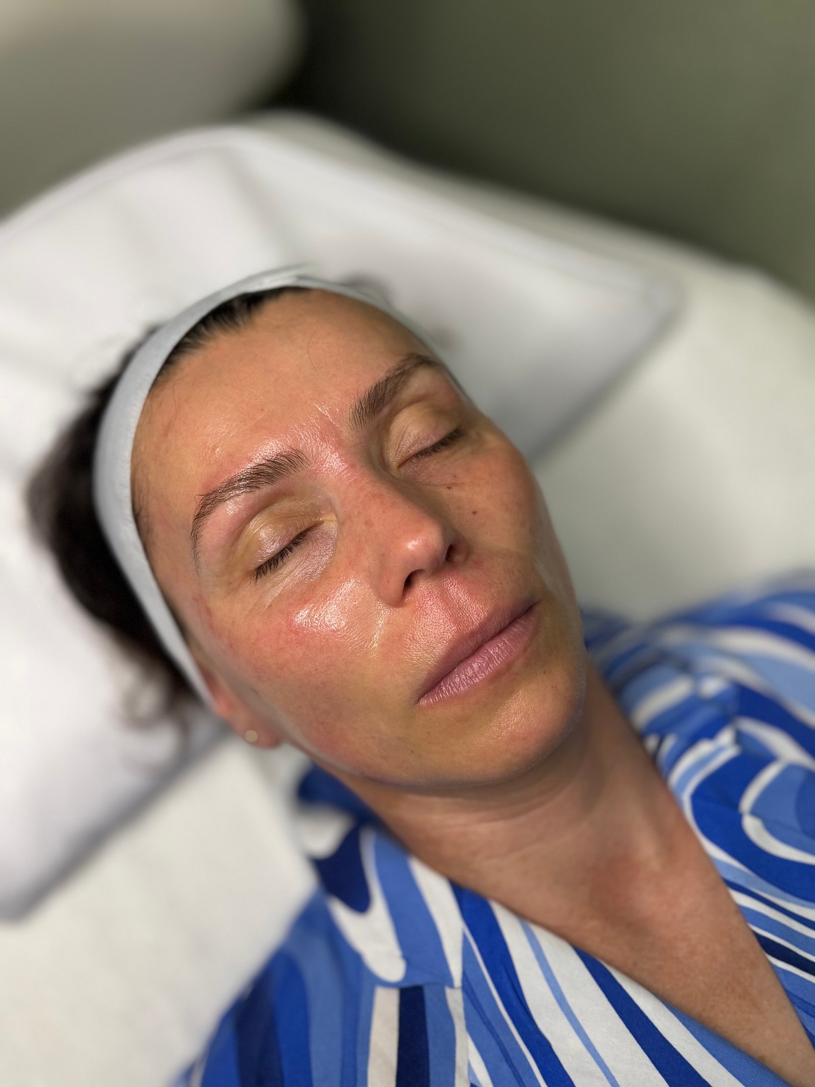 After skin booster