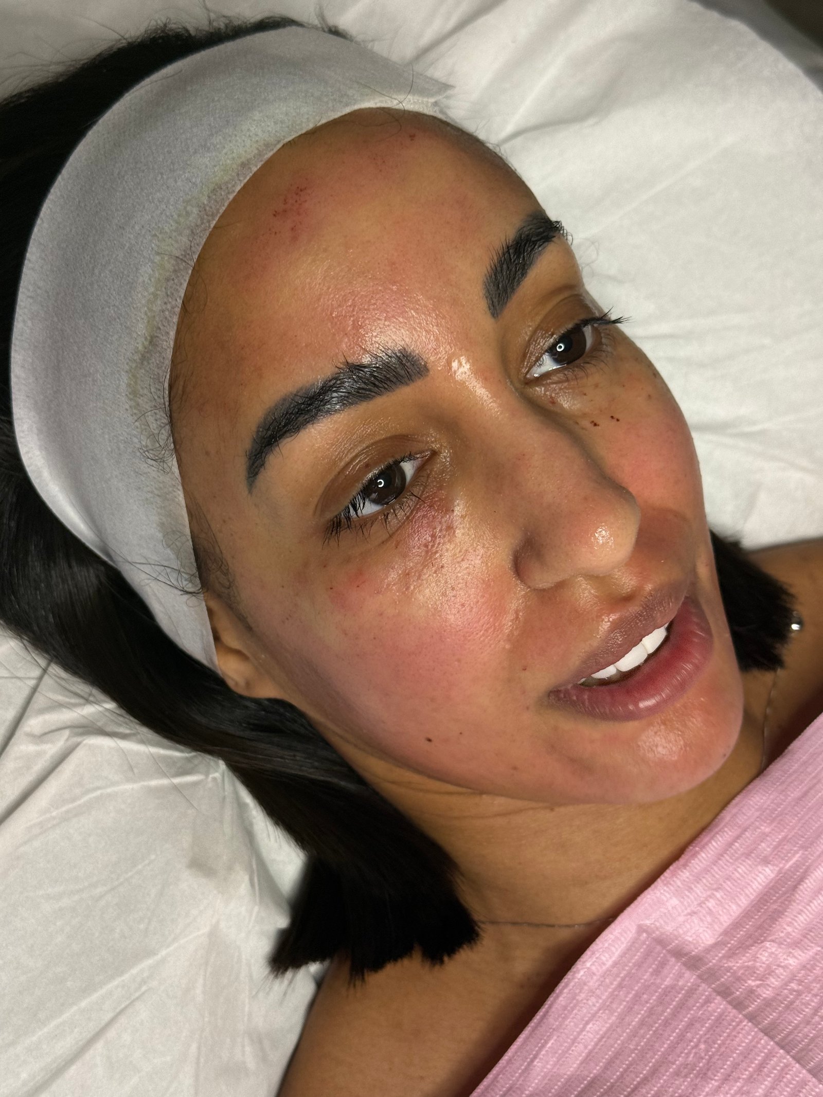 After under-eye rejuvenation