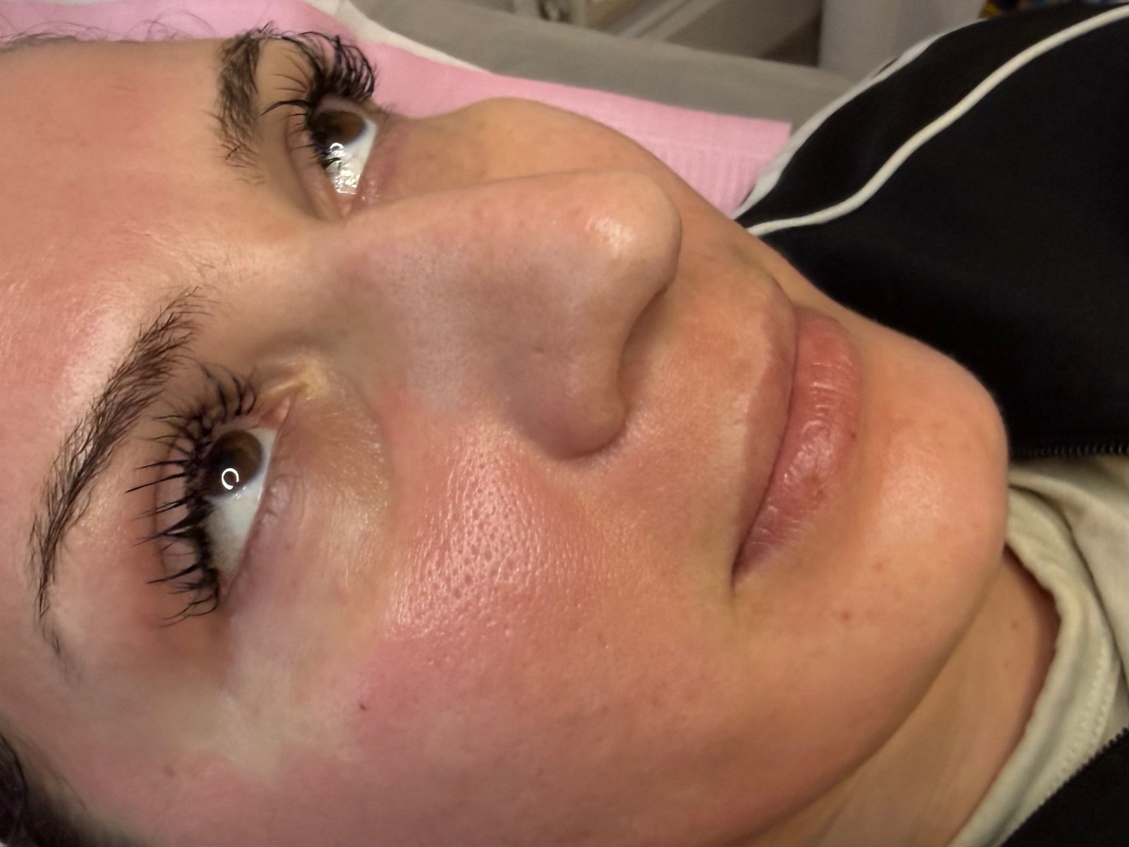 After under-eye rejuvenation