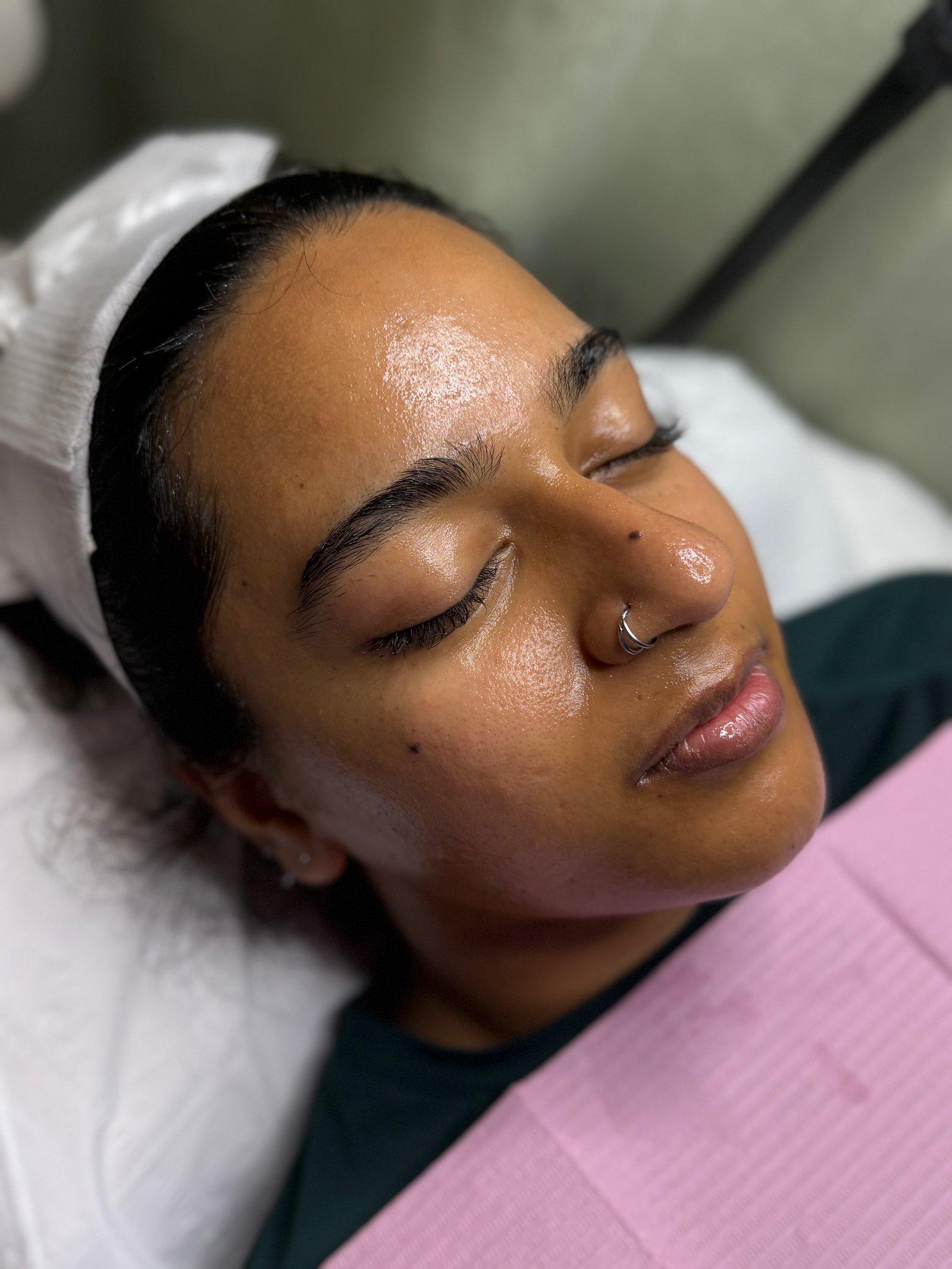 After dermaplaning and microdermabrasion
