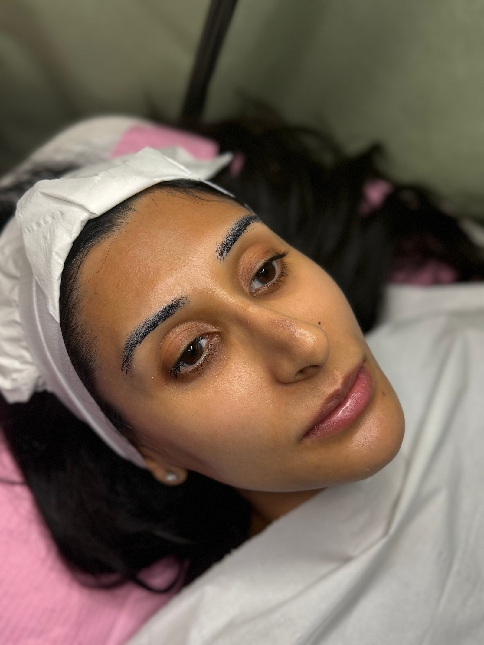 Before microneedling