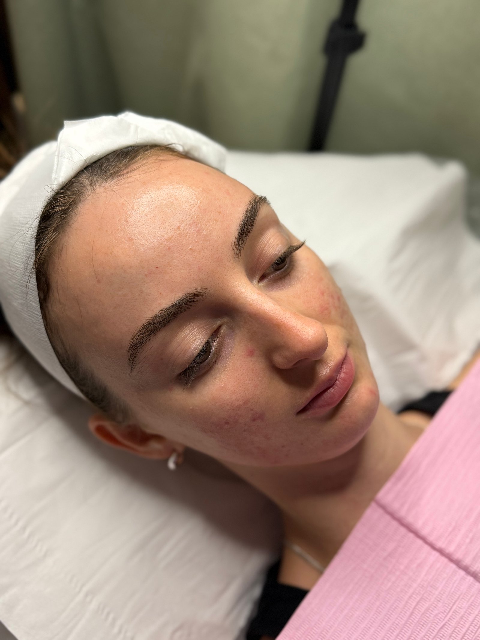Before microneedling