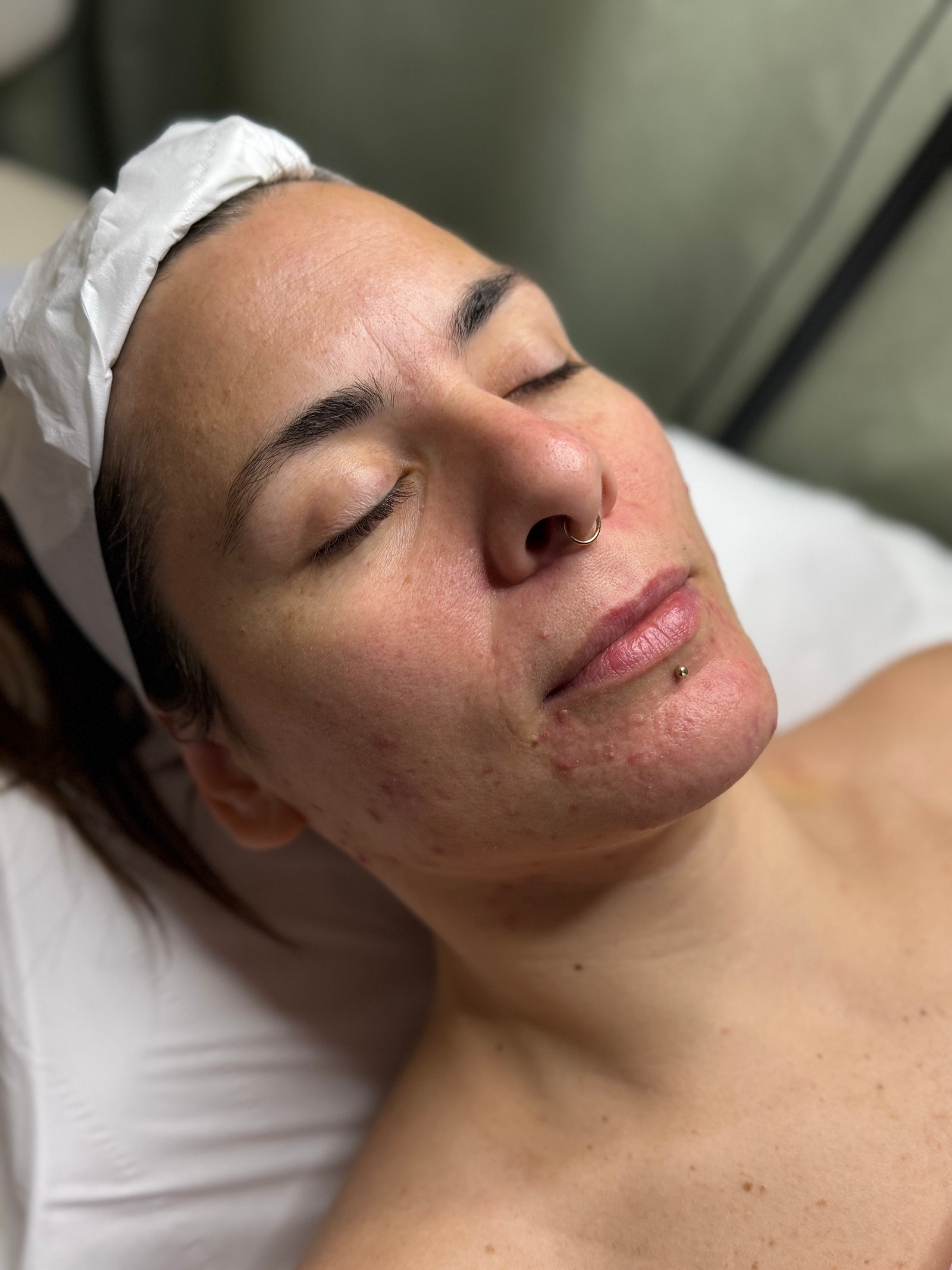 Before facial