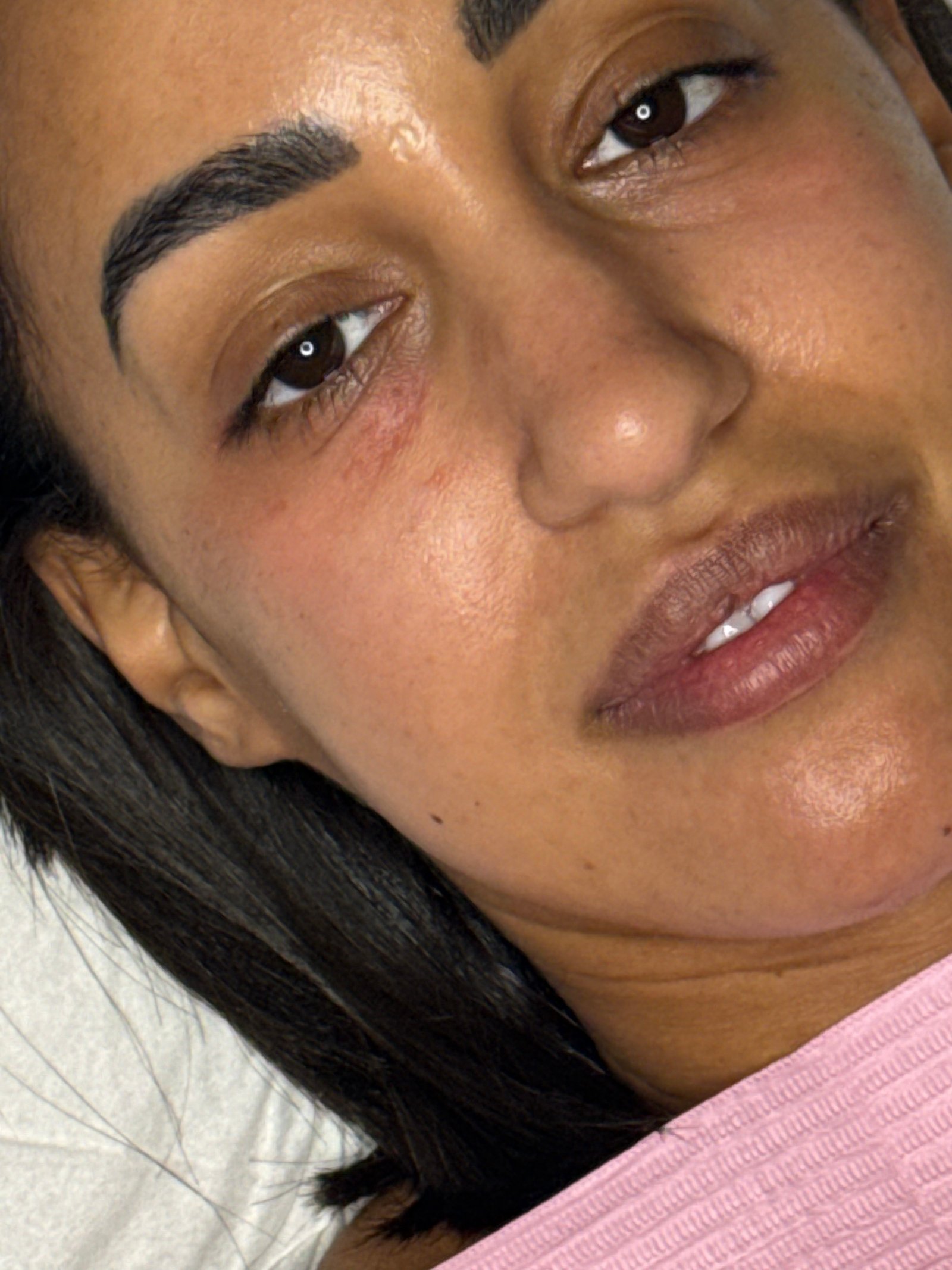 Before under-eye rejuvenation