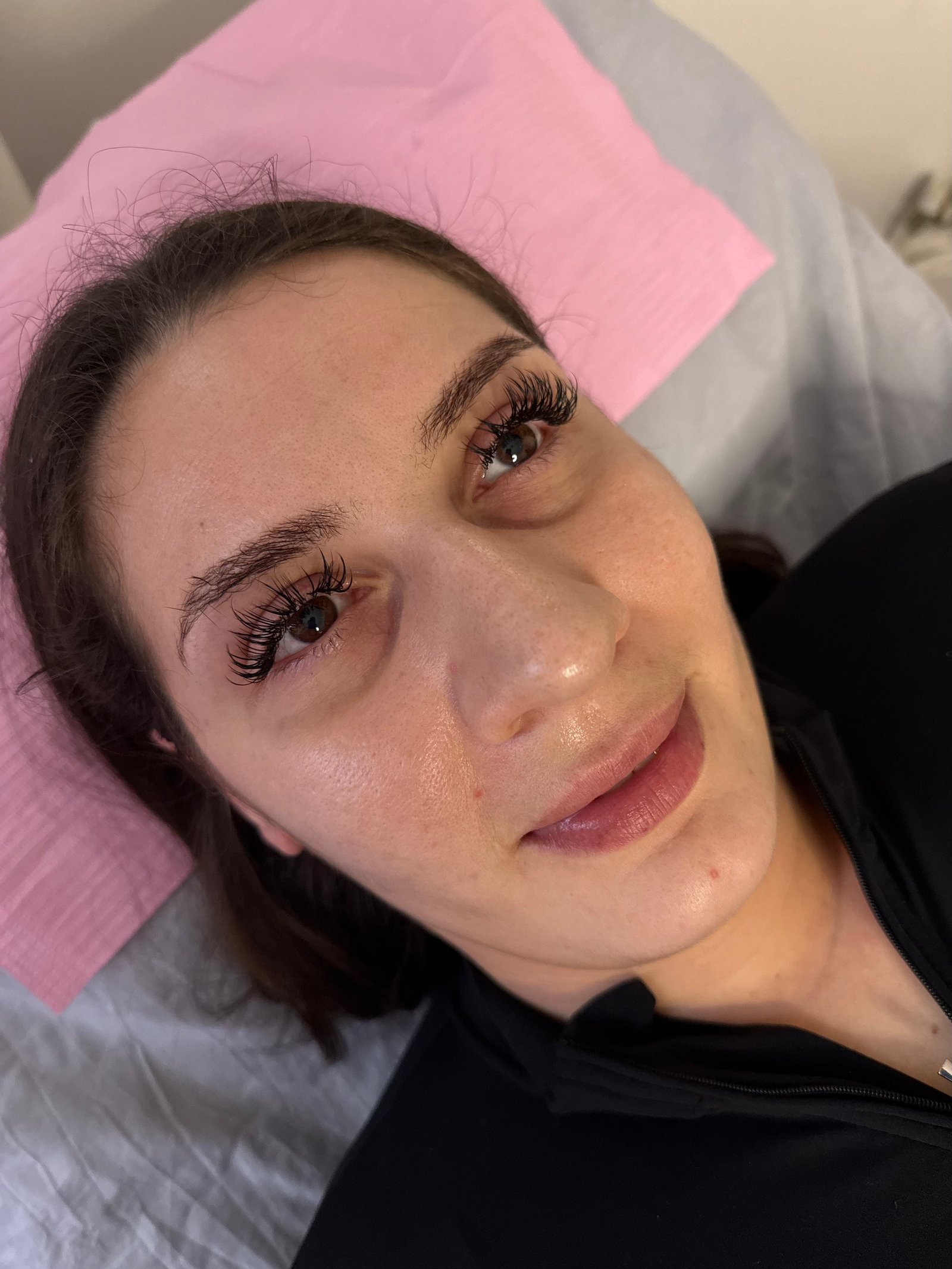 Before under-eye rejuvenation